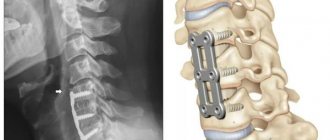 Fixation of the cervical vertebrae