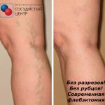 Phlebectomy - surgery for varicose veins through punctures without incisions