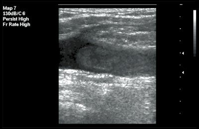 Узи тромбозов. Тромбоз подколенной артерии УЗИ. Тромбоз общей бедренной вены УЗИ. Тромбофлебит малой подкожной вены УЗИ.