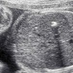 Hyperechogenicity in the fetal heart