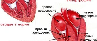 Гипертрофия левого желудочка сердца