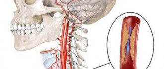 Hypoplasia of the right and left vertebral artery