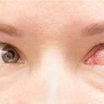 Eye pressure - symptoms and signs