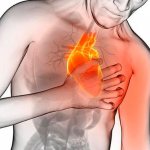 Angina pectoris: First aid for an angina attack