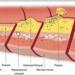Cholesterol in the blood