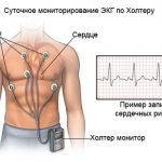 Холтеровское мониторирование ЭКГ