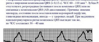 Идиовентрикулярный ритм на ЭКГ. Что это значит, фото, причины и лечение