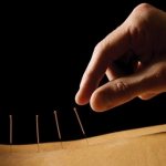 Acupuncture