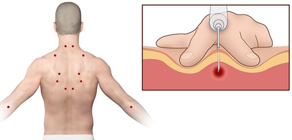 Триггерные точки трапециевидной мышцы