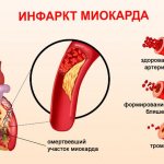 Myocardial infarction