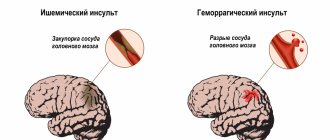 Инсульт.jpg