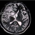 Stroke on MRI of the brain
