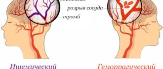 инсульт