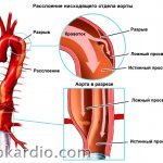 Исчерпывающий обзор разрыва аорты: причины, первая помощь, прогноз - IllnessNews.ru о кардиологии