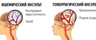 Ишемический инсульт