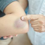 Избавляемся от синяков