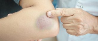 Getting rid of bruises