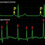 How to diagnose atrial fibrillation