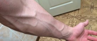 Как избавиться от вен на руках причины
