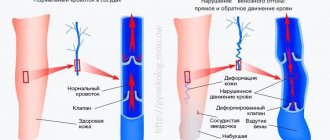 How do pelvic varicose veins form?