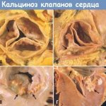 кальциноз-клапанов-сердца.jpg
