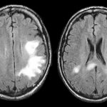 Pictures upon request MRI leukoencephalopathy