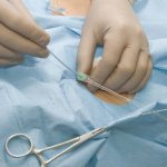 Катетеризация сосуда