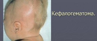 Cephalohematoma