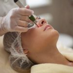 Coagulation of nasal vessels using laser method surgery