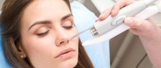 Coagulation of nasal vessels using laser method