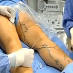 Combined phlebectomy