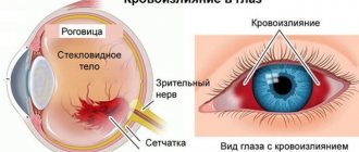 bleeding in the eye