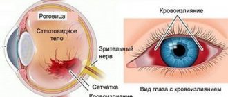 Кровоизлияние в глаз