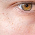 Ксантелазмы на лице