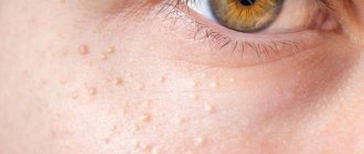Ксантелазмы на лице