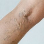 Treatment of phlebitis