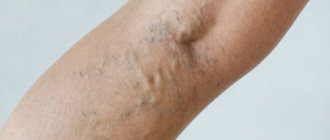 Treatment of phlebitis