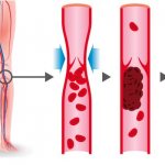 Treatment of thrombosis