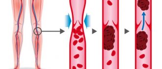 Treatment of thrombosis
