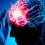 Left-sided ischemic stroke