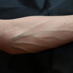 лопнул сосуд на запястье