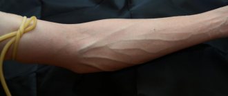 burst blood vessel on the wrist