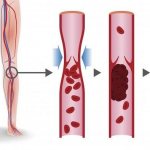 The mechanism of development of deep vein thrombosis
