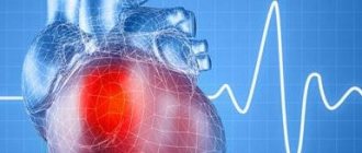 Atrial fibrillation