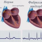 Atrial fibrillation