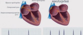 Atrial fibrillation