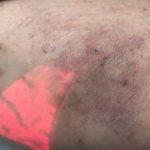 Meshing and hyperpigmentation after microsclerotherapy
