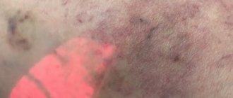 Меттинг и гиперпигментация после микросклеротерапии