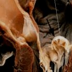 Myxomatous mitral valve degeneration