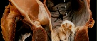 Myxomatous mitral valve degeneration